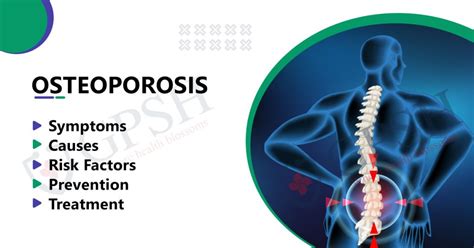osteoporosis treatment falls church|Osteoporosis Guide: Causes, Symptoms and Treatment .